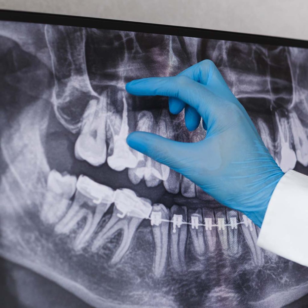 Dental X-ray showing teeth and jaw structure during an exam at Elite Dental & Wellness in Mesa, AZ